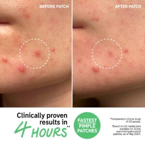 The INKEY List Hydrocolloid Invisible Pimple Patches + Salicylic Acid - Imagen 6